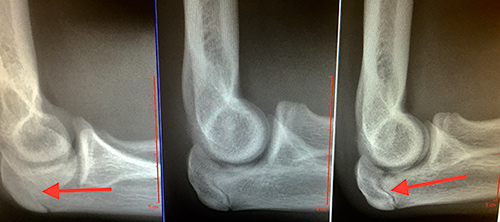 fracture olecranon stress elbow elbows treatment hamate hook orange arthroscopy